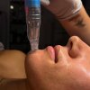 Collagen Induction Therapy/Microneedling