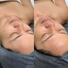 Acne Treatment