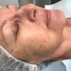 Customised Chemical Peel