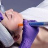 Collagen Induction Therapy/Microneedling