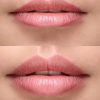 Lip Enhancement Treatment